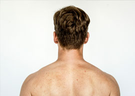 Photo of a man's back as part of a full skin check