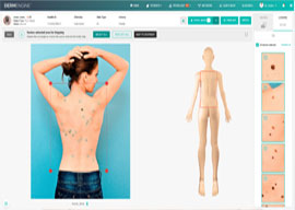 Total Body Photography using the Dermengine software